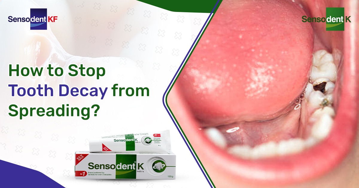 How to Stop Tooth Decay from Spreading